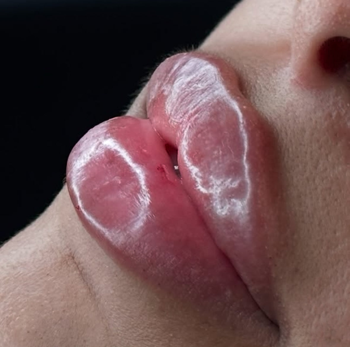 Lip Filler