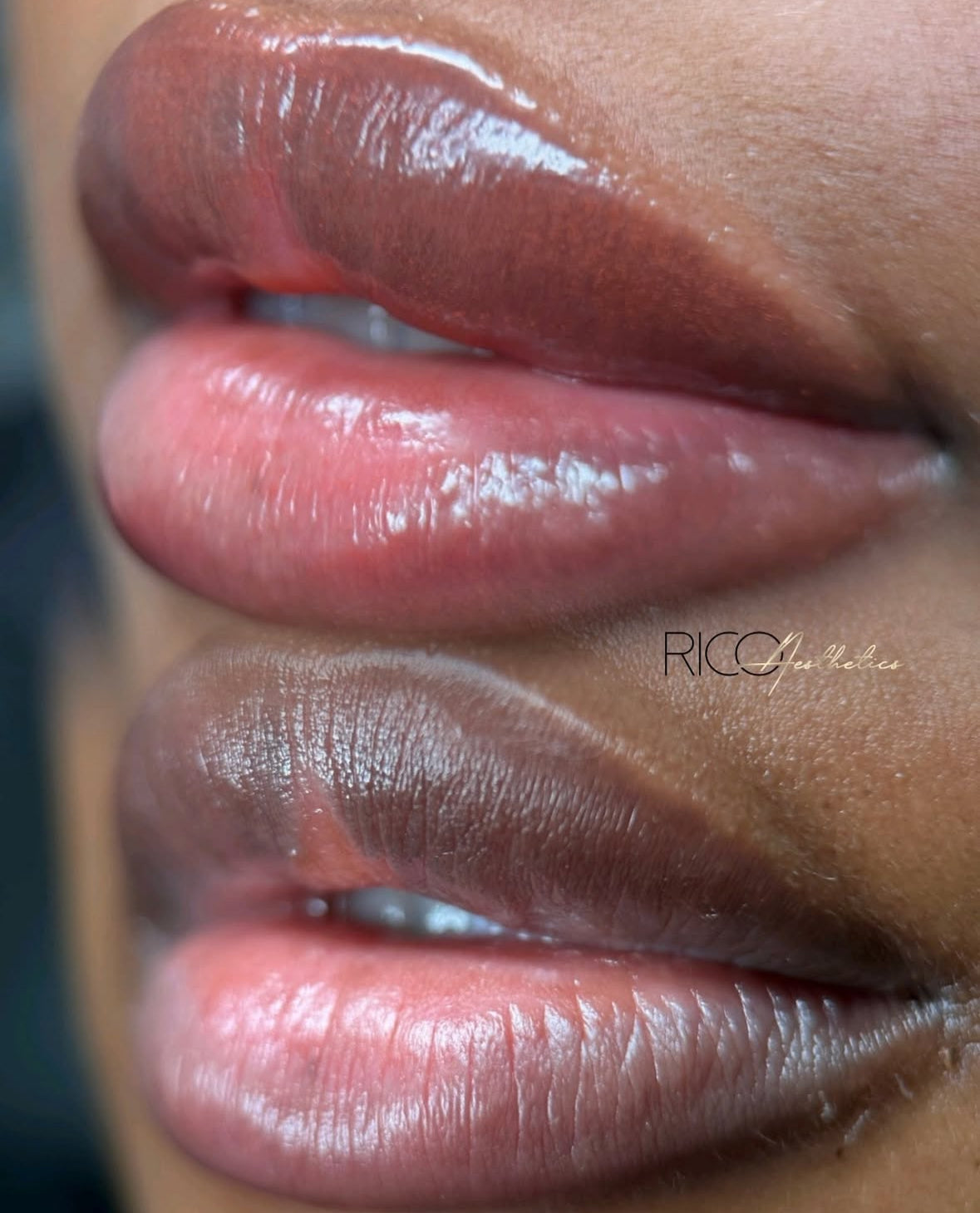 Dark Lip Neutralisation