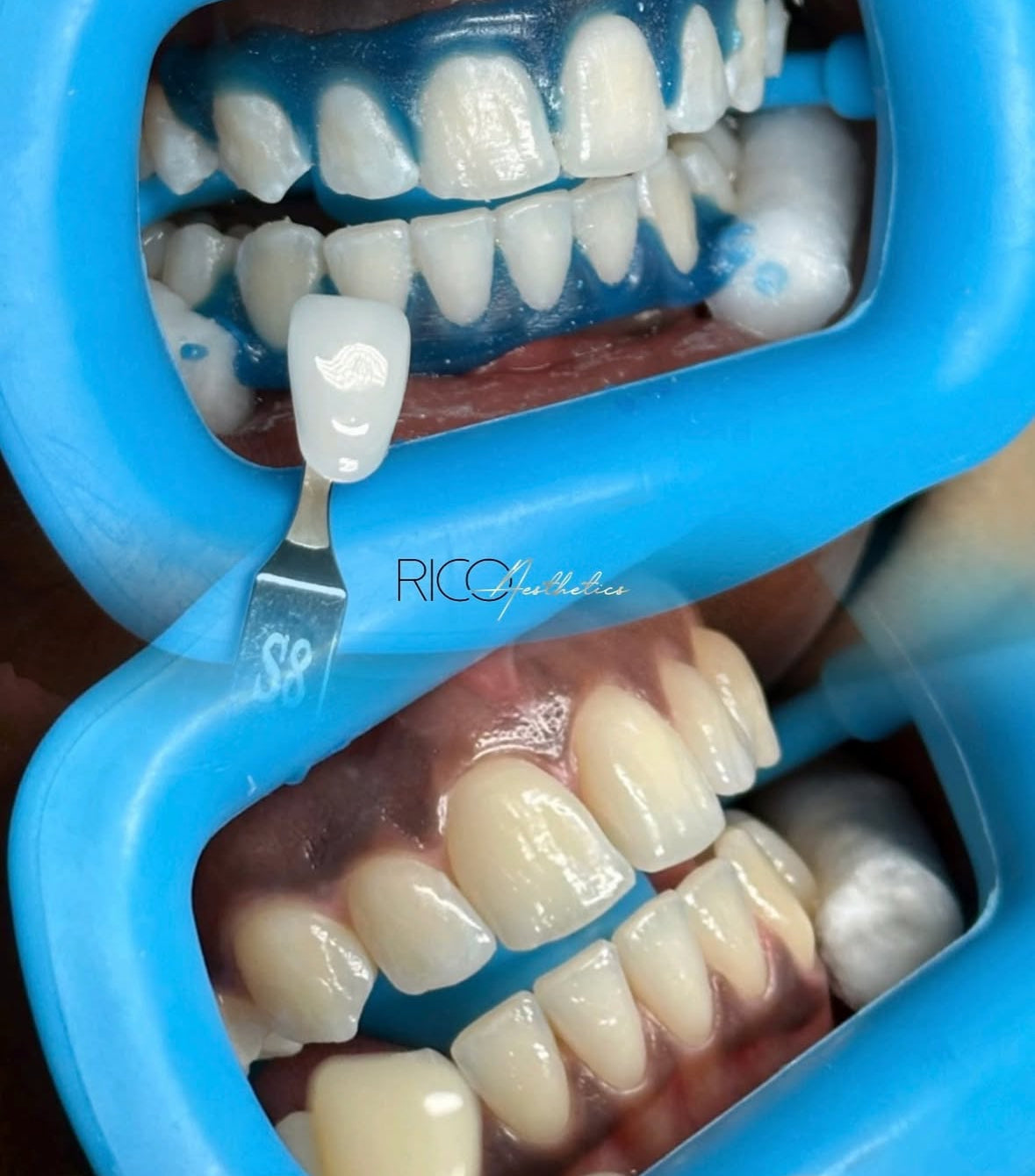 Teeth Whitening