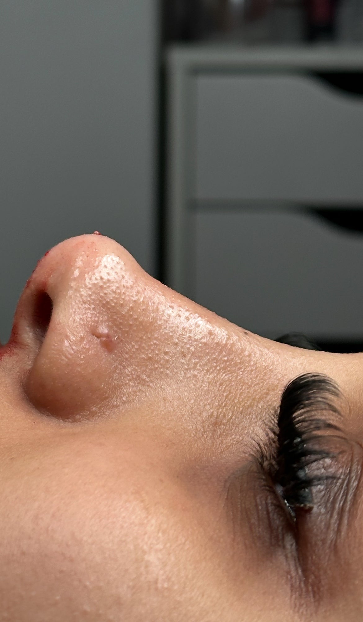 Liquid Rhinoplasty