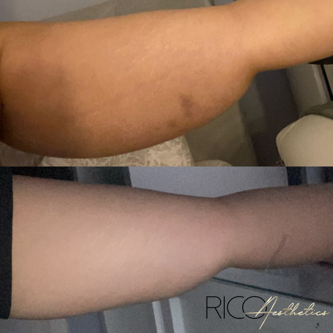 Lemon Bottle Fat Dissolving