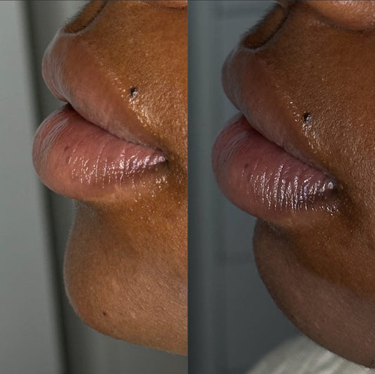 Chin Filler
