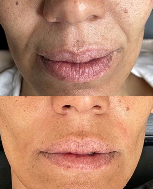 Nasolabial Filler (smile lines)