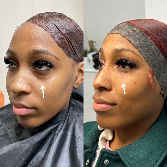 Tear Trough Filler
