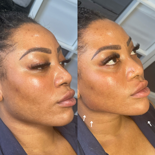 Jaw Filler